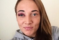 K.Druskytė „pasipuošė“ mėlyne po akimi („Instagram“ nuotr.)