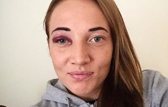 K.Druskytė „pasipuošė“ mėlyne po akimi („Instagram“ nuotr.)