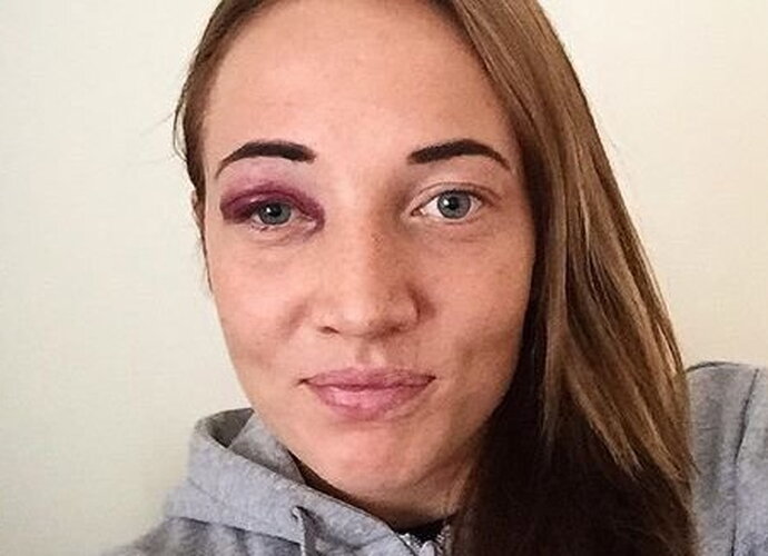K.Druskytė „pasipuošė“ mėlyne po akimi („Instagram“ nuotr.)